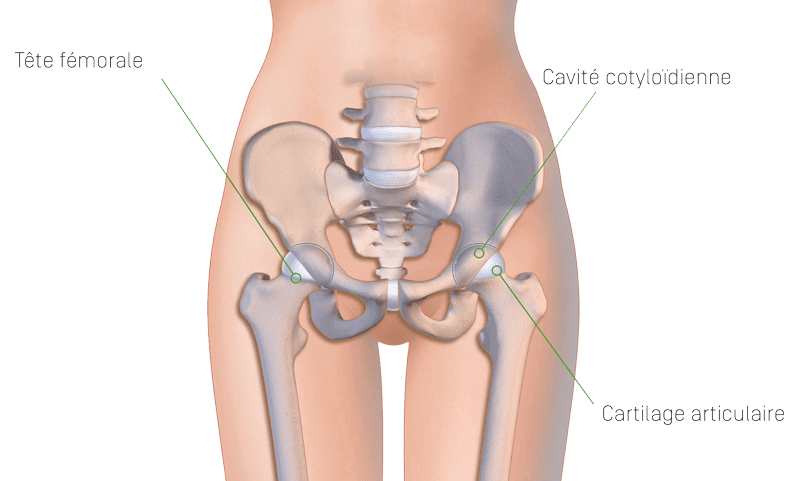 Prothèse de hanche - Symbios
